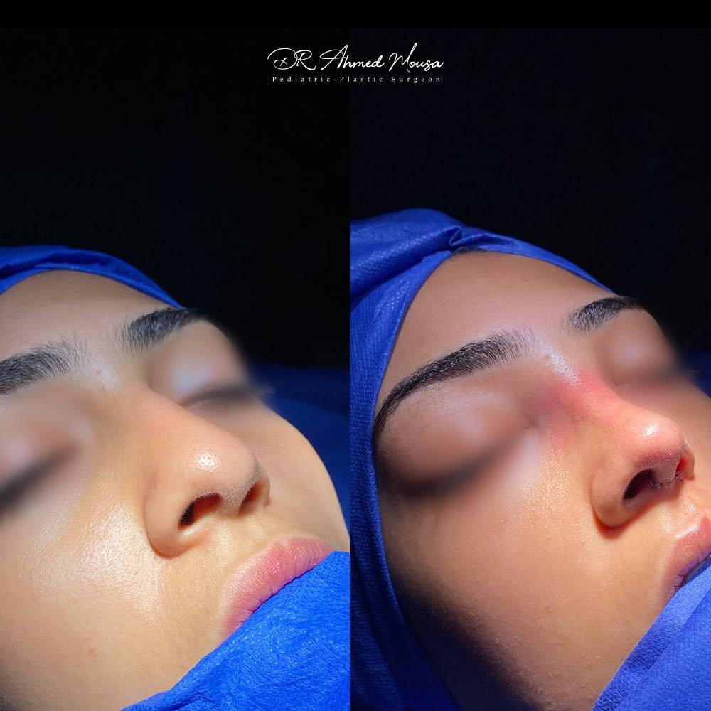 تجميل الأنف - حالة 2