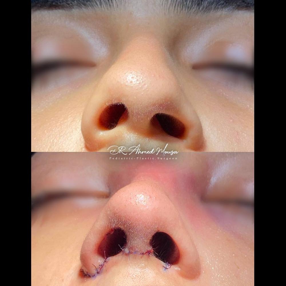 تجميل الأنف - حالة 3