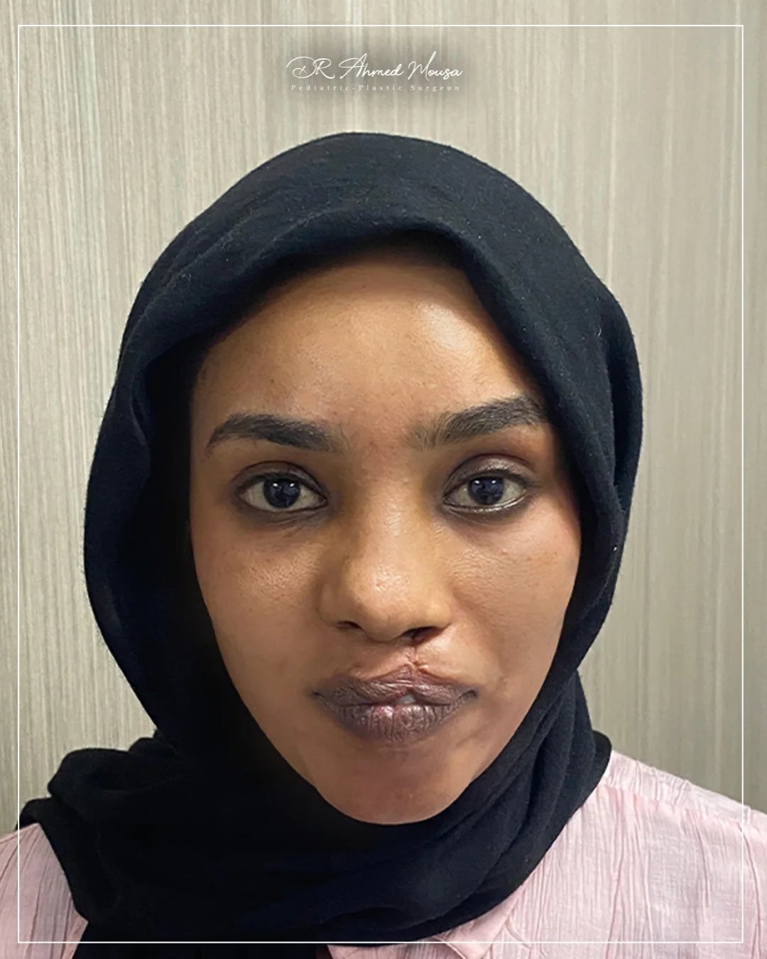 إصلاح الشفة الأرنبية - بعد